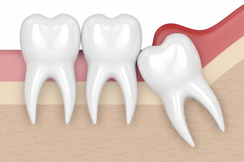 Wisdom Tooth Removal in Homewood